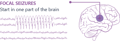 Focal seizures vs. generalized seizures